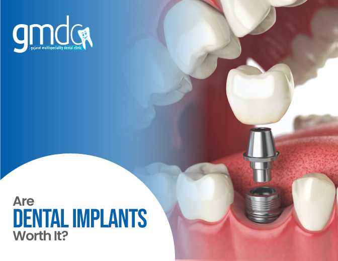 Dental Implants