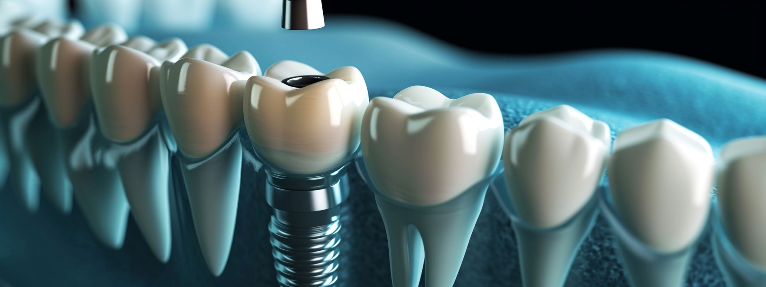 dental implant