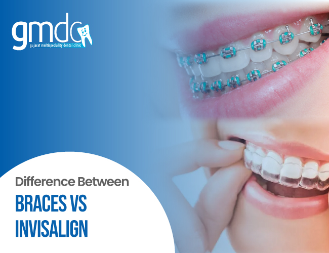 Braces Vs Invisalign