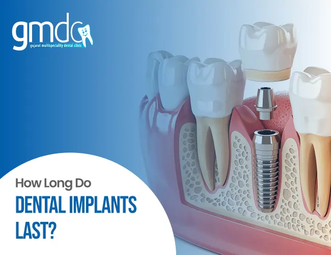 how long do dental implants last